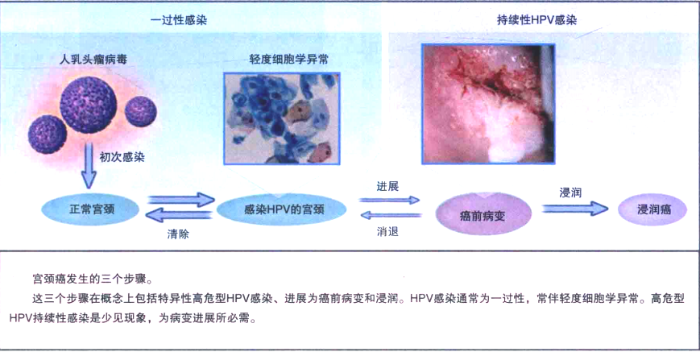 圖1 正常宮頸感染高危型HPV后進展到宮頸癌的模式圖